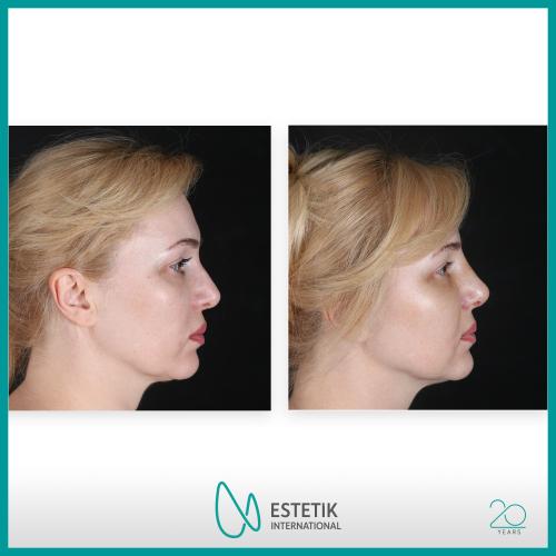 Before after photos of our patients 0